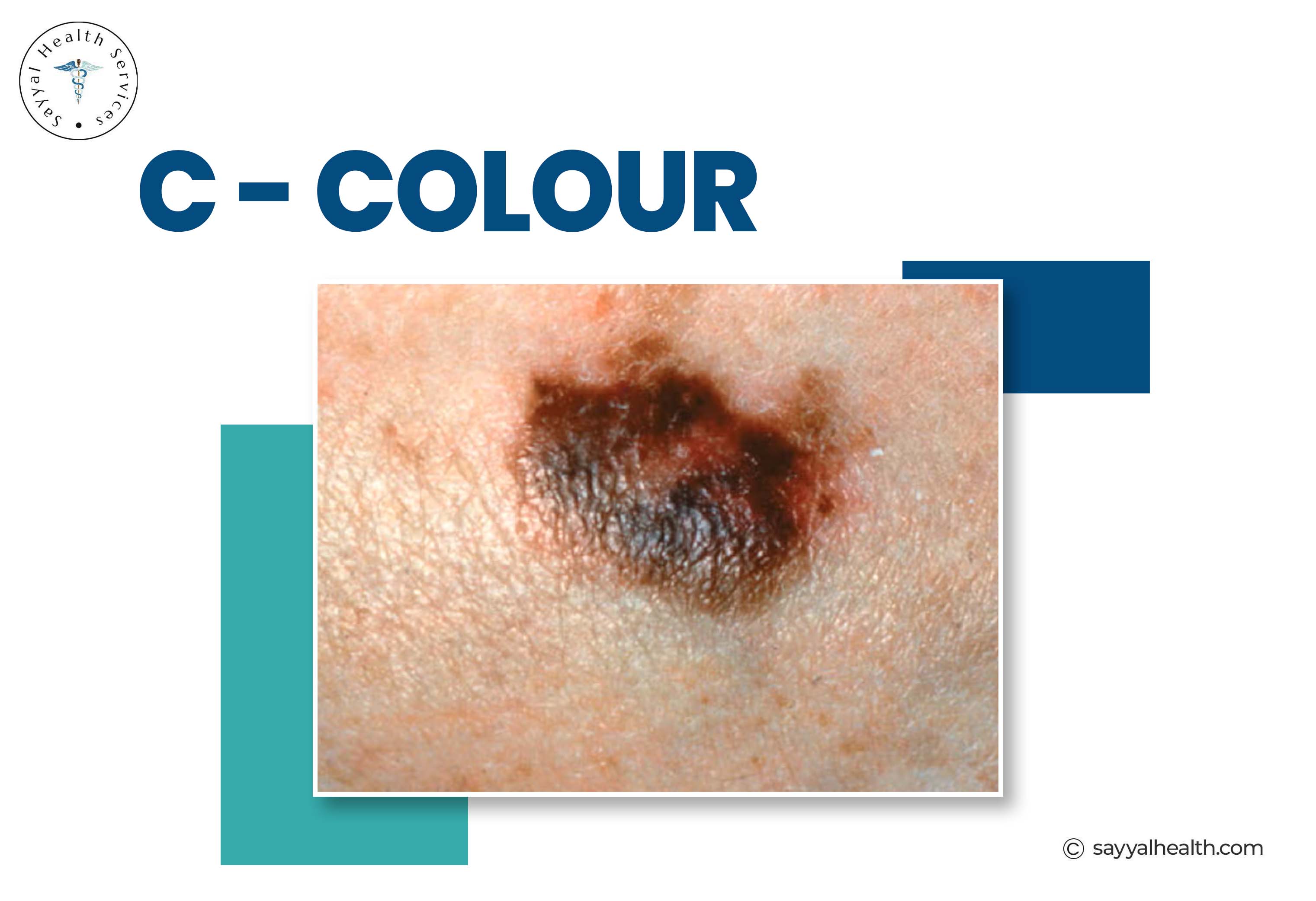 Melanoma color variation - multi-colored mole with brown, black, and red tones